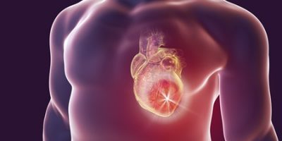 UK (University of Glasgow) 60-Minute Iron Treatment Averts Heart Failure Hospital Admissions