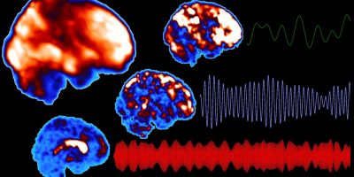 Finland (University of Oulu) Abnormal brain pulsations found in the brains of people with narcolepsy