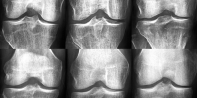 Finland (University of Jyväskylä) AI-generated x-ray images fooled medical experts and improved osteoarthritis classification